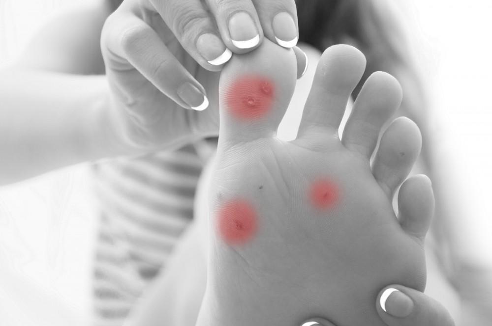 How to Get Rid of a Painful Wart